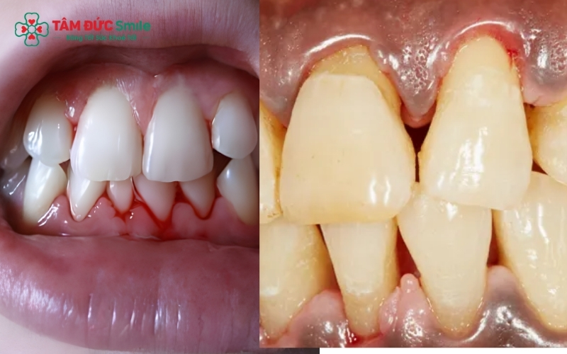 Chảy máu chân răng và tụt nướu là những dấu hiệu điển hình cảnh báo mô nha chu đang bị tổn thương