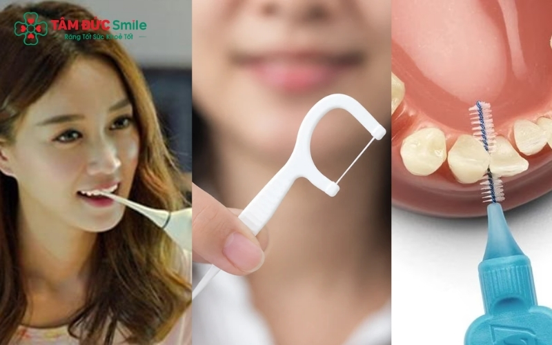 Vệ sinh kẽ răng bằng máy tăm nước hoặc bàn chải kẽ là bước quan trọng để kiểm soát mảng bám và ngăn ngừa viêm nha chu tái phát.