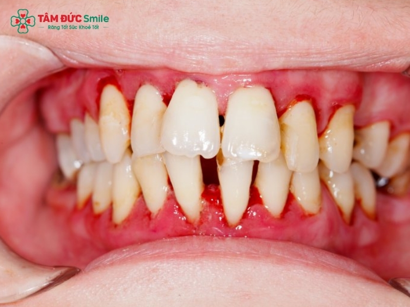Viêm nha chu: Dấu hiệu, nguyên nhân và cách điều trị hiệu quả