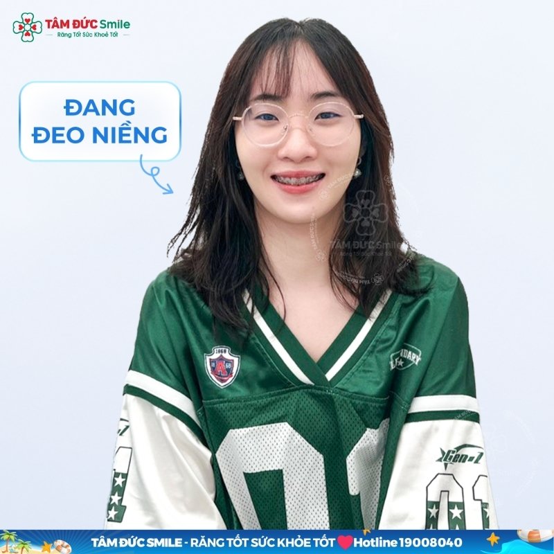 Người 26 tuổi vẫn có thể niềng răng để cải thiện thẩm mỹ nụ cười