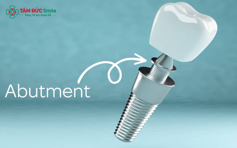Abutment là bộ phận trung gian gắn kết trụ Implant với mão răng
