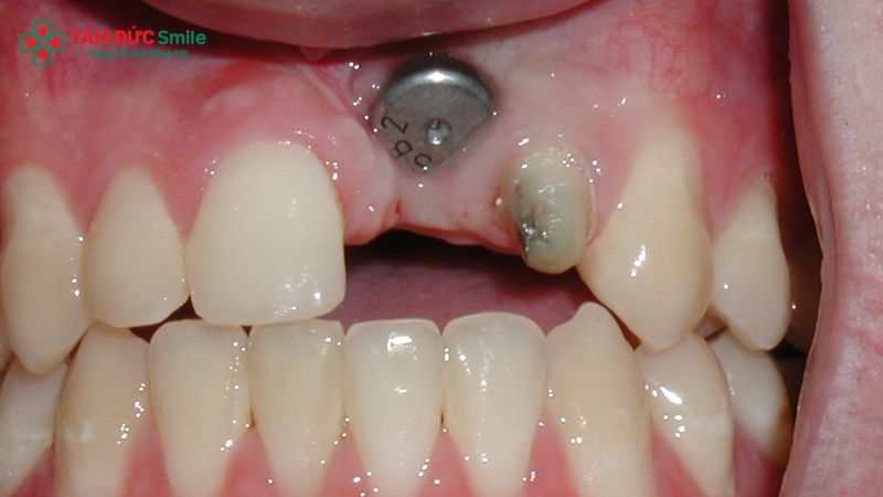 bien-chung-khi-cay-ghep-implant-4