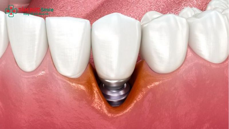 bien-chung-khi-cay-ghep-implant-5