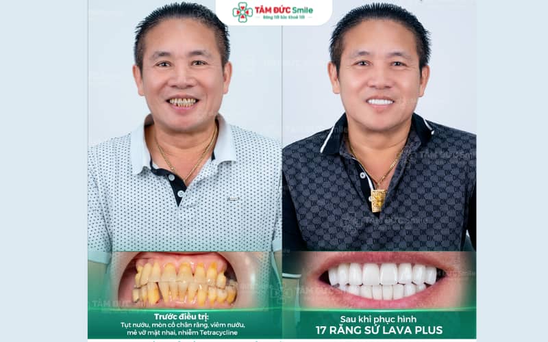 Bọc răng sứ Nha khoa Tâm Đức Smile Ninh Kiều giải pháp thẩm mỹ và độ bền vượt trội