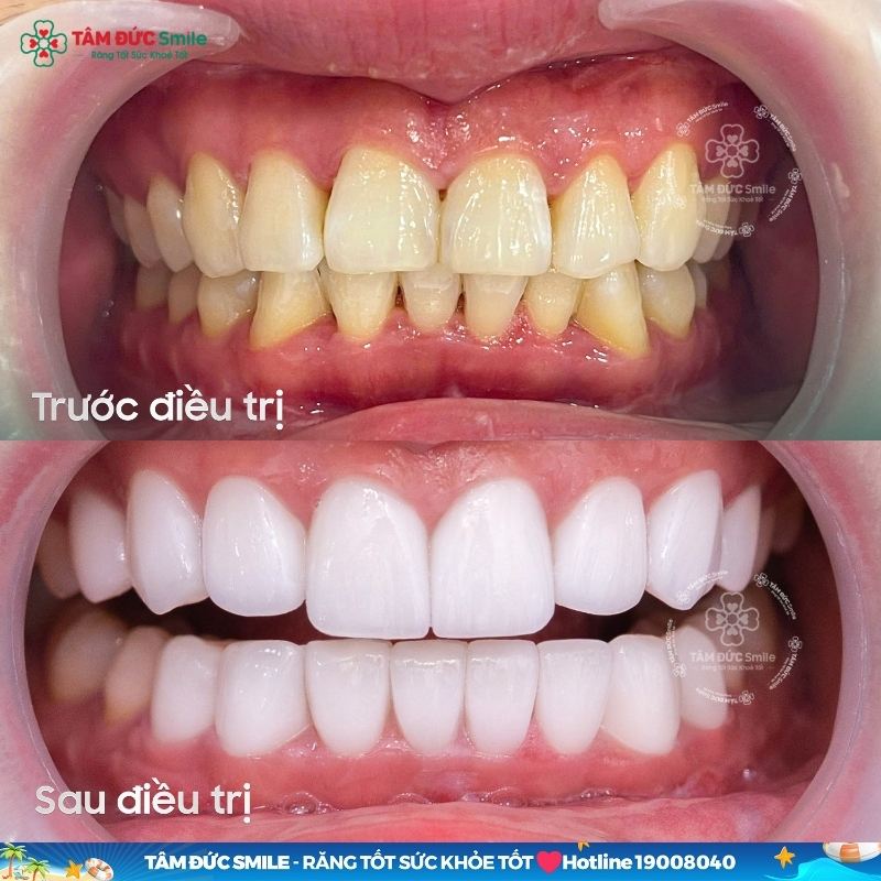 Bọc răng sứ giúp cải thiện thẩm mỹ và khả năng ăn nhai