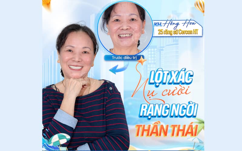 Răng sứ thẩm mỹ – lựa chọn hoàn hảo nhờ độ bền lâu dài và an toàn