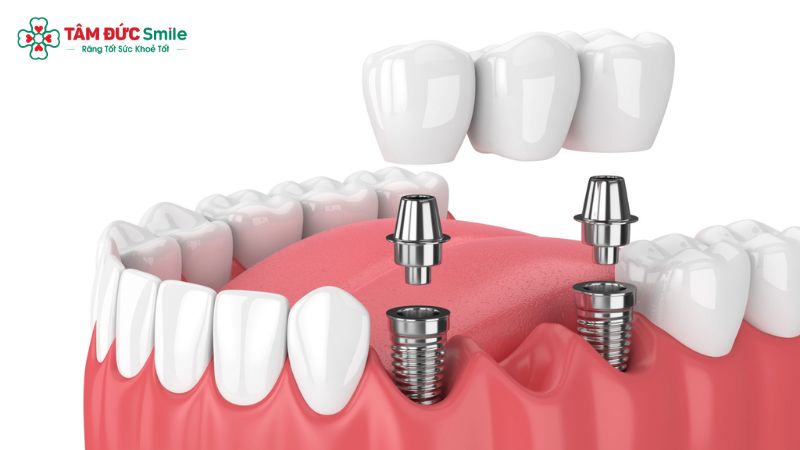 cau-tao-rang-implant-3