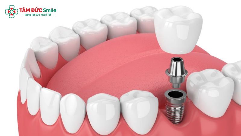 cau-tao-rang-implant-4