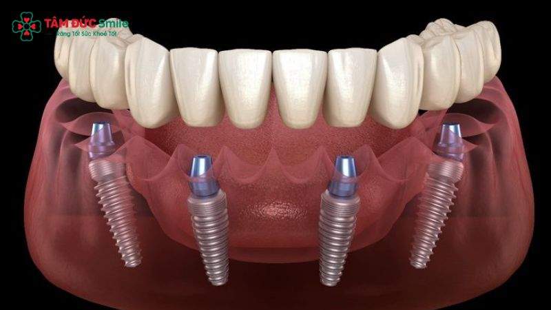 cau-tao-rang-implant-5