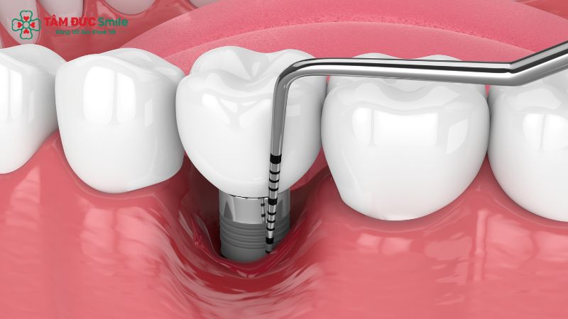 Một số biến chứng: viêm nhiễm, trụ lỏng, đau kéo dài – cần phát hiện sớm và xử lý kịp thời.