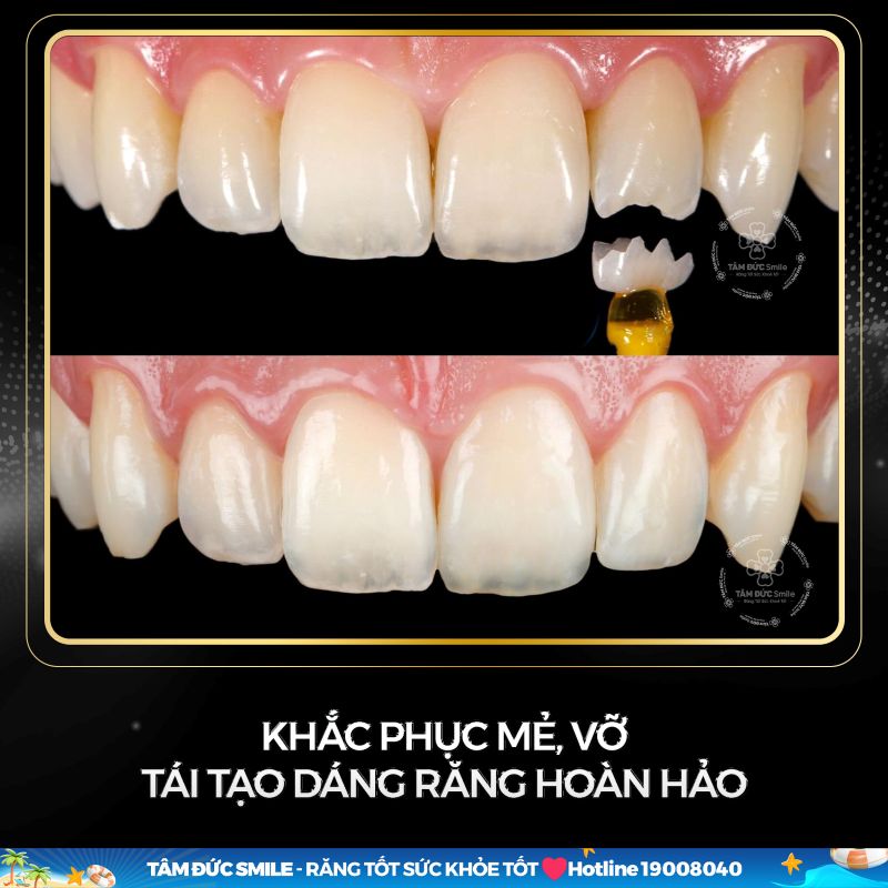 dan-su-veneer-1