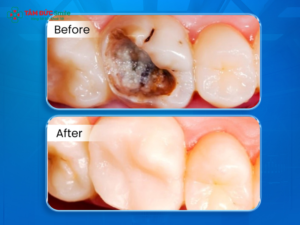 Composite có màu gần giống răng thật, phù hợp phục hồi các vị trí cần tính thẩm mỹ