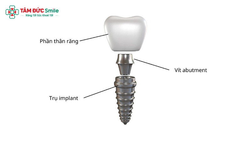 do-ben-rang-implant-1