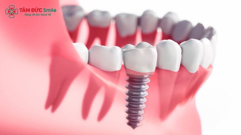 do-ben-rang-implant-4