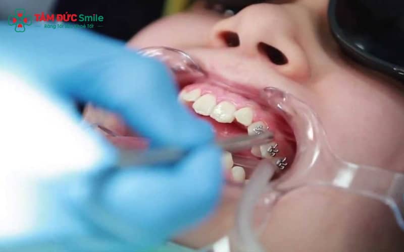 Tại Tâm Đức Smile, gắn mắc cài được thực hiện theo quy trình 5 bước an toàn – chính xác