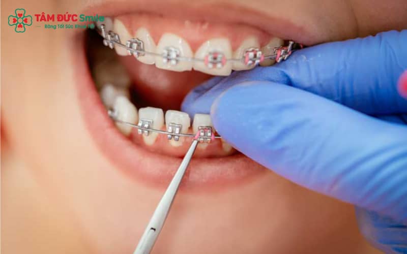 Sau khi gắn mắc cài, quý khách sẽ được siết dây lần đầu trong khoảng 2–4 tuần