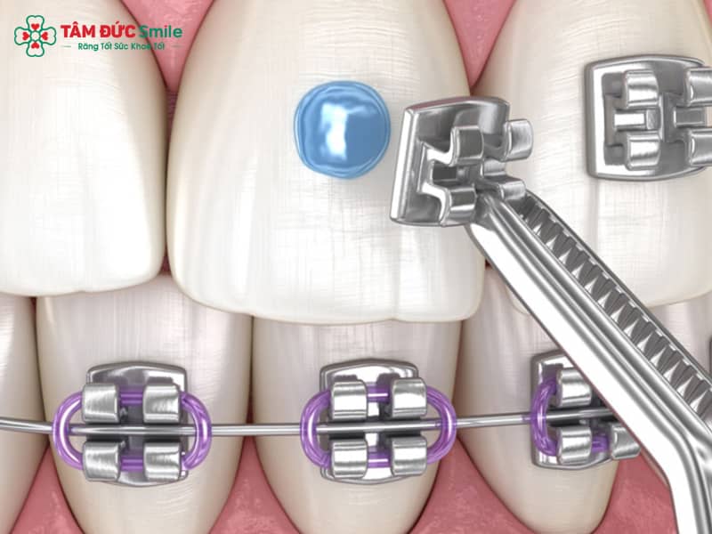 Gắn mắc cài có đau không? Quy trình – chi phí – cách chăm sóc sau khi gắn