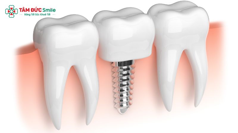 implant-tuc-thi-1