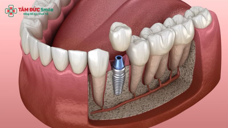 implant-tuc-thi-2