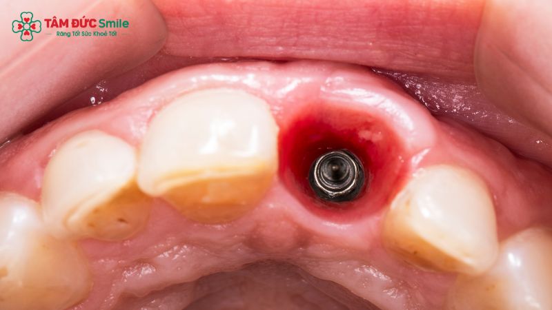 implant-tuc-thi-5