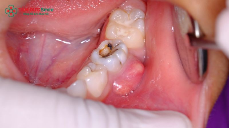 implant-tuc-thi-6