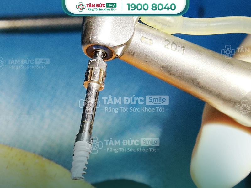 kha-nang-chiu-luc-cua-implant-1