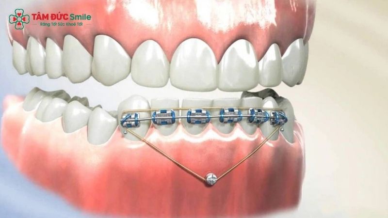 Minivis niềng răng có công dụng hỗ trợ răng dịch chuyển đúng hướng trong quá trình chỉnh nha