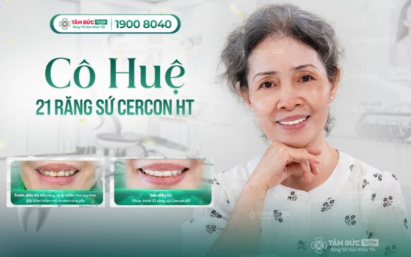 Dịch vụ bọc răng sứ thẩm mỹ cho hàm răng đều đẹp