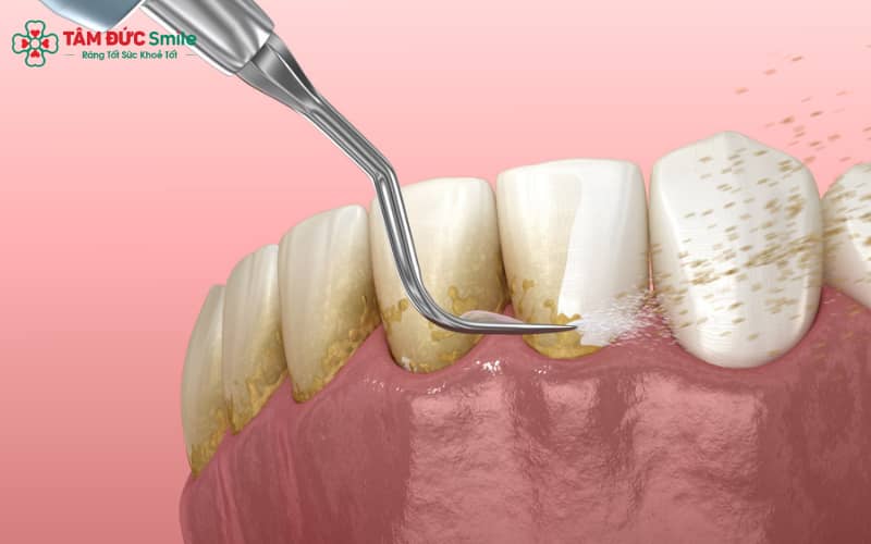Giải pháp cạo vôi giúp bảo vệ nướu, phòng ngừa nha chu