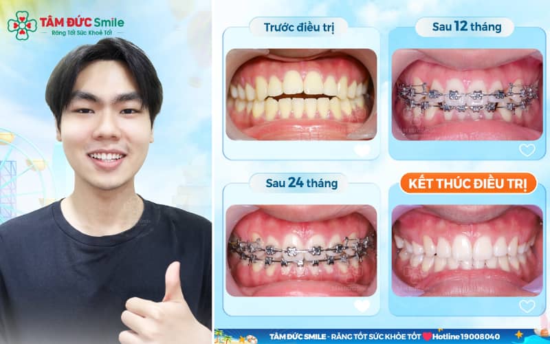 Dịch vụ chỉnh nha mắc cài kim loại an toàn, hiệu quả ở Cần Thơ