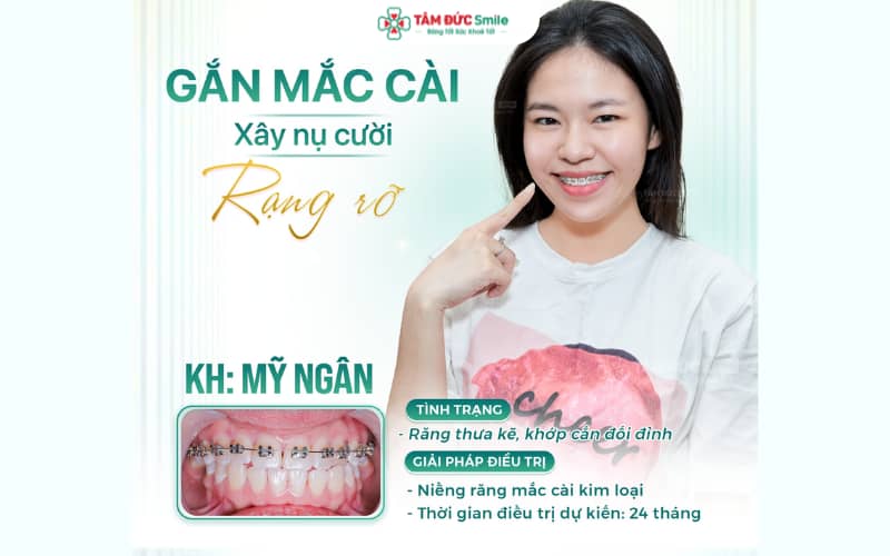 Chỉnh nha mắc cài kim loại an toàn tại Tâm Đức Smile Đồng Nai