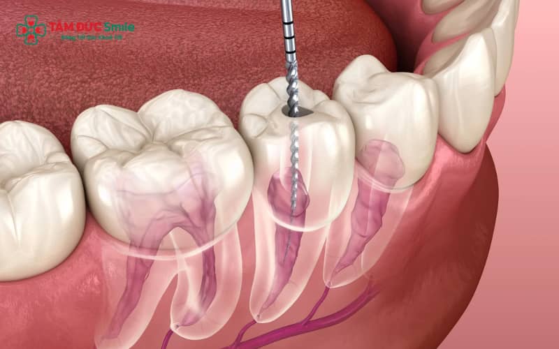 Quy trình chữa tủy, phục hình răng nhẹ nhàng, an toàn