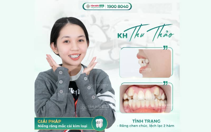 Niềng răng mắc cài kim loại giúp cải thiện khớp cắn hiệu quả với chi phí tối ưu