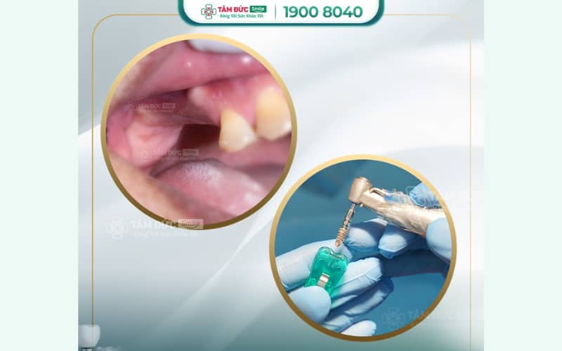 Cấy ghép Implant tại Hóc Môn giúp khôi phục răng mất bền vững