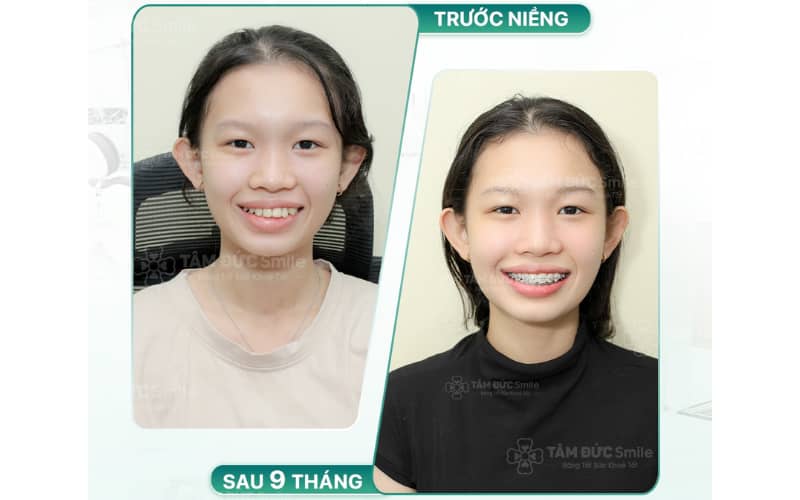 Niềng răng tại Ninh Kiều mang lại hiệu quả chỉnh nha cao