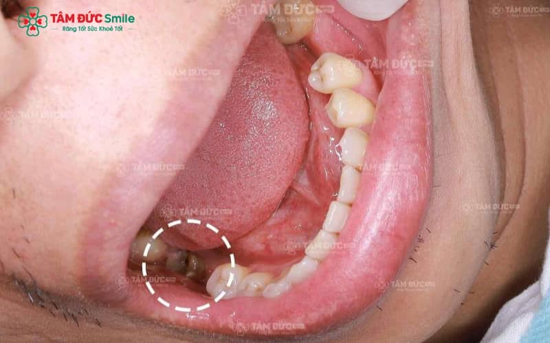 Chữa tủy không đau, phục hình răng thẩm mỹ tại Tâm Đức Smile