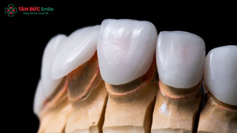 Dán sứ Veneer – mang đến nụ cười trắng sáng tự nhiên.