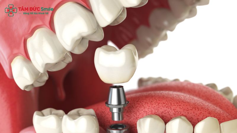 Cấy ghép Implant toàn hàm với công nghệ hiện đại.