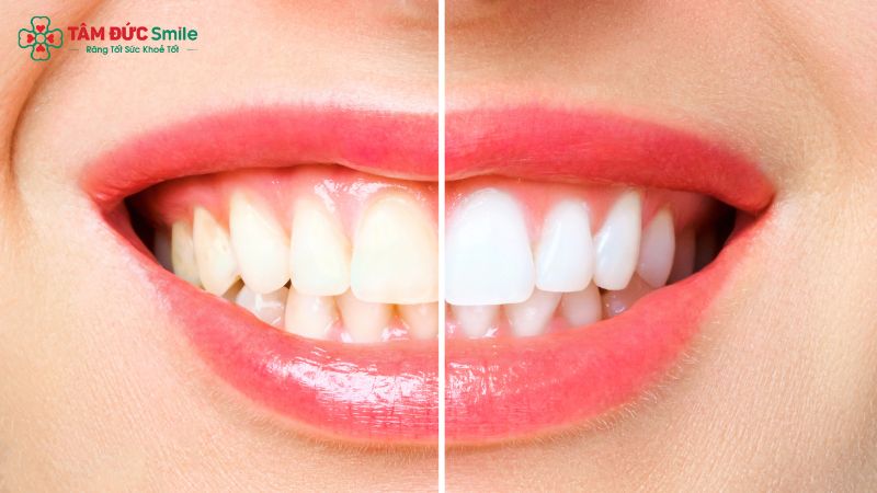 Tẩy trắng răng an toàn, không ê buốt tại Nha khoa Tâm Đức Smile.