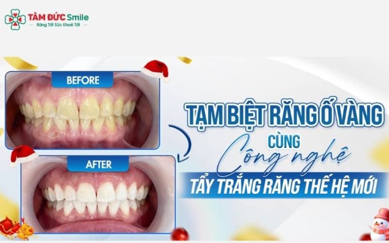 Công nghệ Laser Whitening mang lại hàm răng trắng sáng tự nhiên