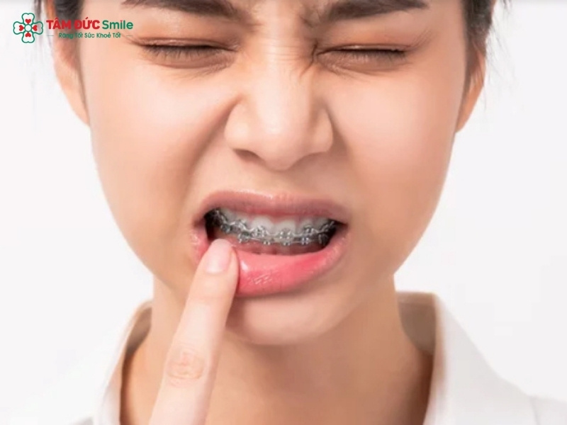 Niềng răng bị sưng nướu thường xuất hiện trong giai đoạn đầu chỉnh nha