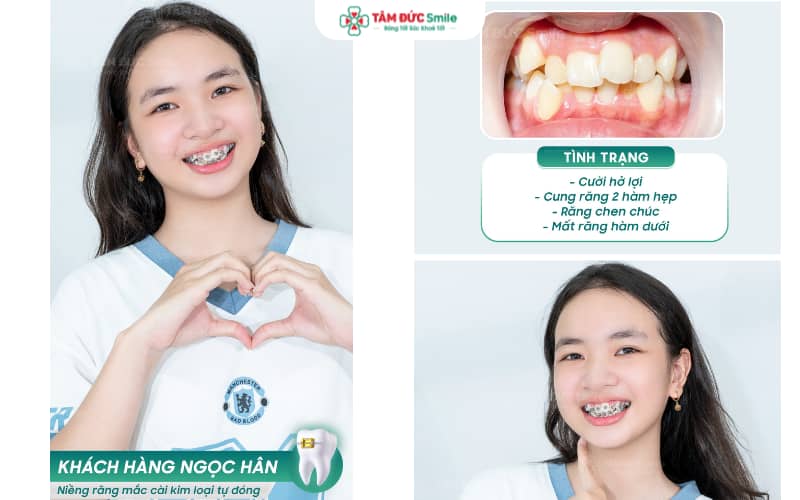 Giải pháp niềng răng thẩm mỹ giúp khách hàng thêm tự tin trong giao tiếp
