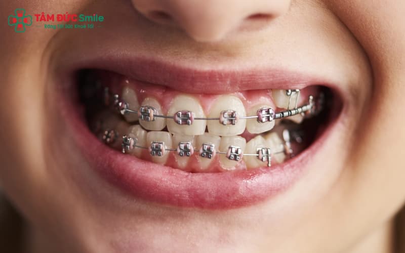 Niềng răng người lớn giúp cải thiện ăn nhai và giảm đau khớp thái dương hàm