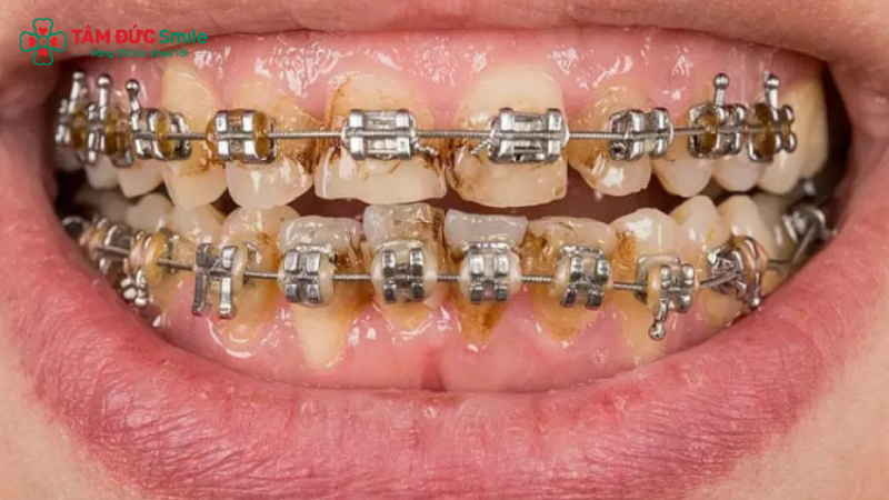Không vệ sinh kỹ khi niềng răng dễ gây mảng bám và cao răng nghiêm trọng