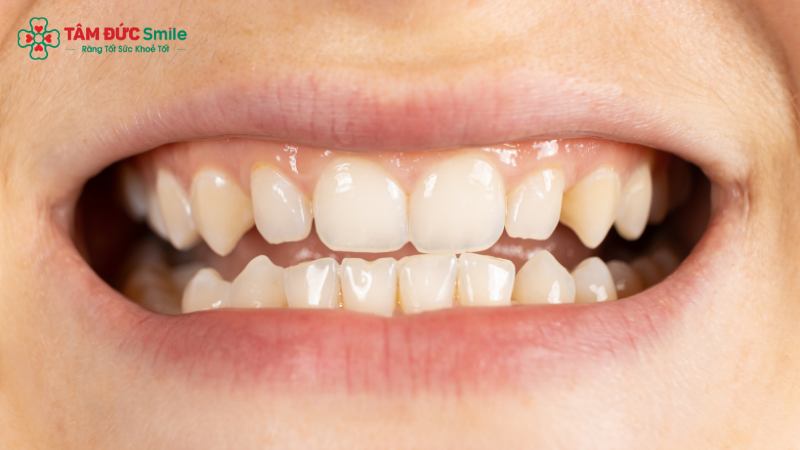 nieng-rang-invisalign-4