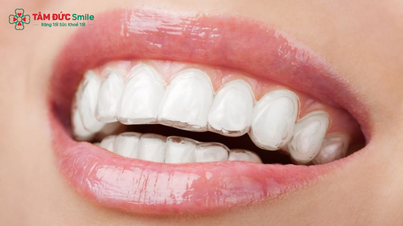 nieng-rang-invisalign-5