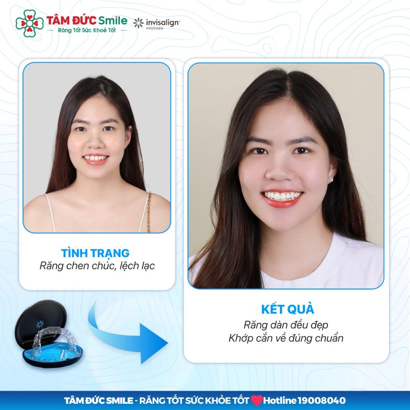 nieng-rang-invisalign-7