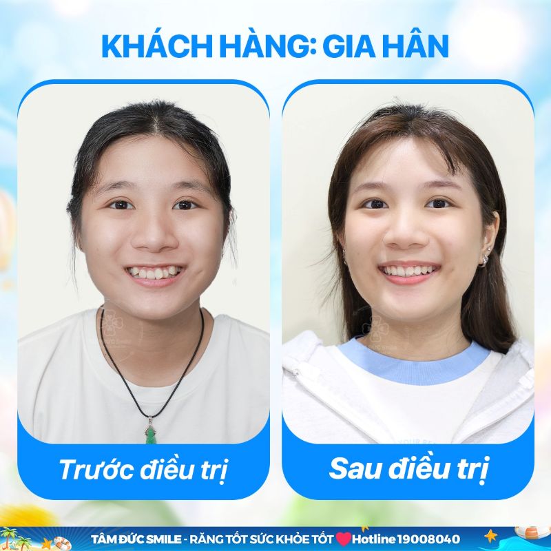 nieng-rang-invisalign-8