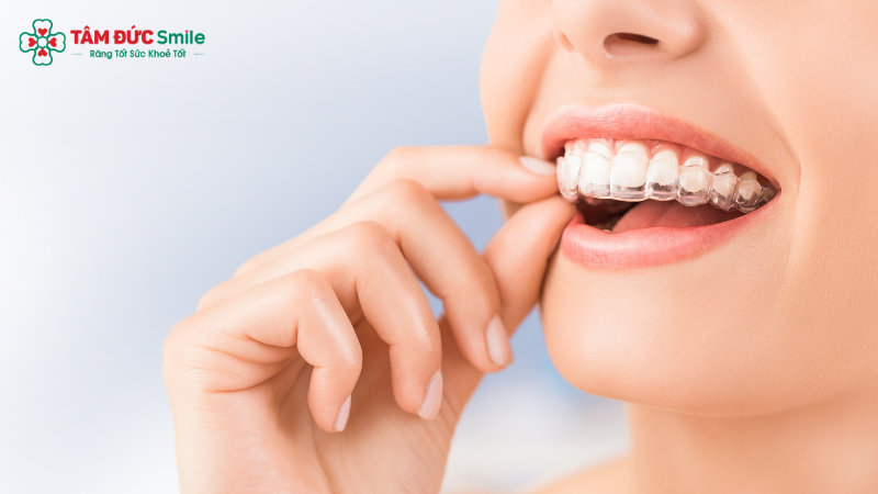 nieng-rang-invisalign-la-gi-5