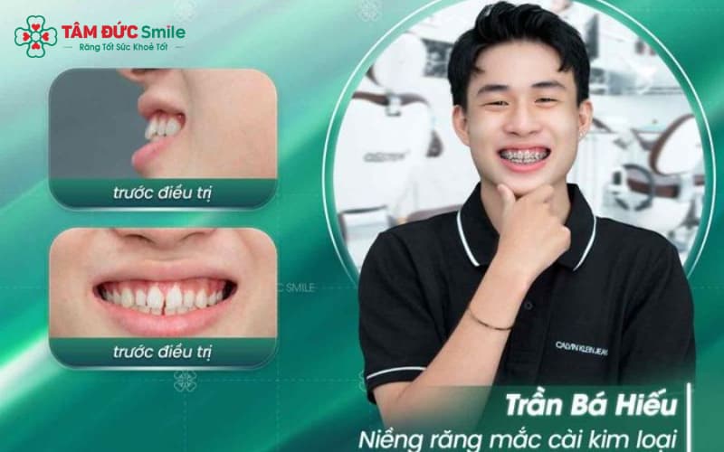 Khách hàng niềng răng không nhổ răng thành công tại Nha Khoa Tâm Đức Smile Khách hàng niềng răng không nhổ răng thành công tại Nha Khoa Tâm Đức Smile